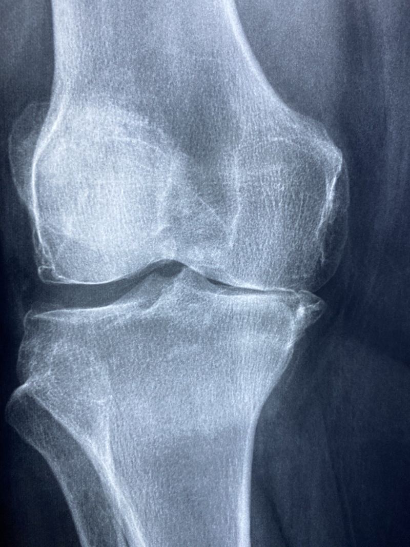 Old woman showing clear signs of arthritis in both hands, with fingers drifting away from the thumb.