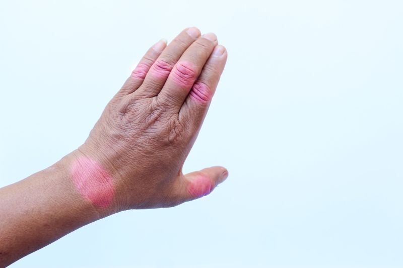 Old woman showing clear signs of arthritis in both hands, with fingers drifting away from the thumb.
