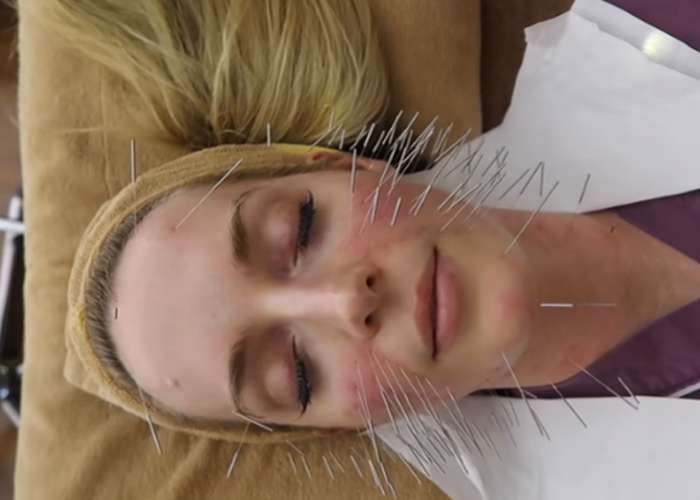 Acupuncture for skin anti-aging: needles inserted in a woman's face during an acupuncture session to reduce skin wrinkles.